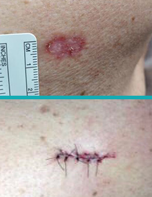Cirugía dermatológica