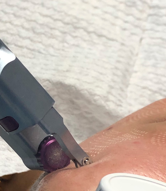 eliminación de tatuajes