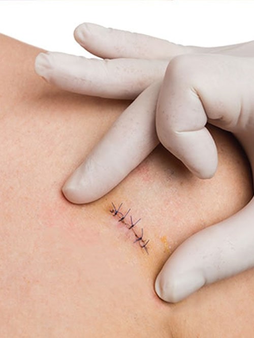 Cirugía dermatológica