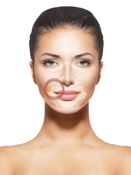 Mujer con vitíligo, revisión dermatológica clínica